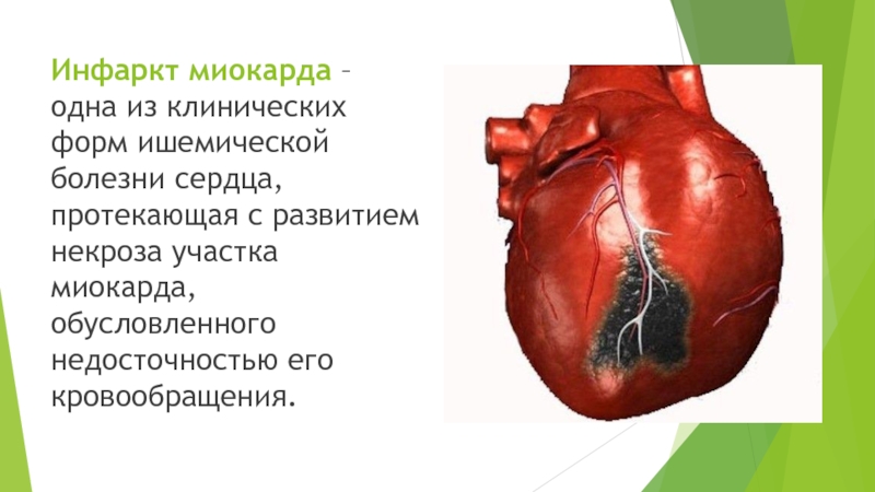 Курсовая работа по теме Сестринский процесс при заболеваниях сердечно-сосудистой системы. Инфаркт миокарда