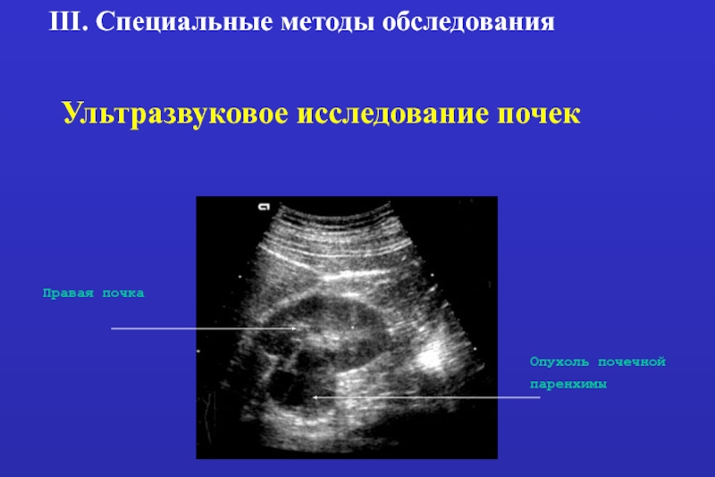 Рак почки узи картина