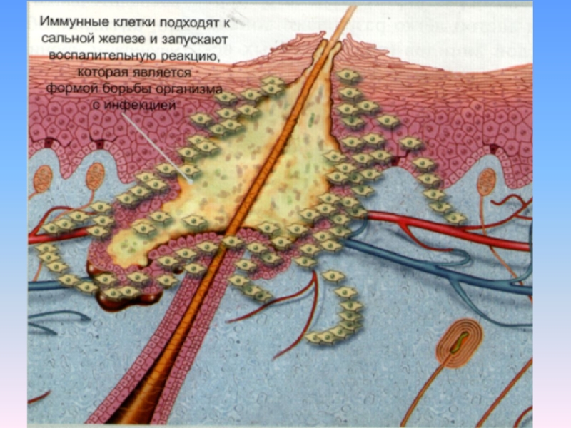 Патогенез акне схема