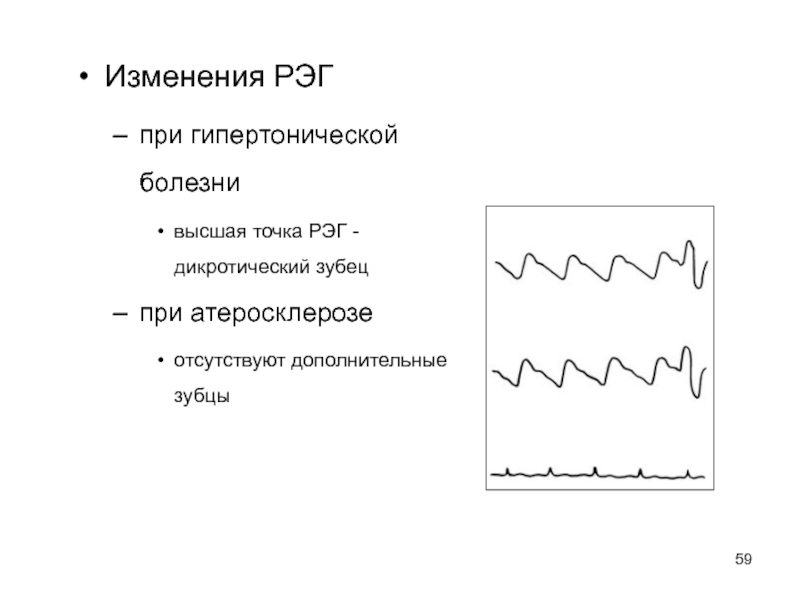 Дикротическая выемка