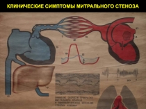Митральные пороки  