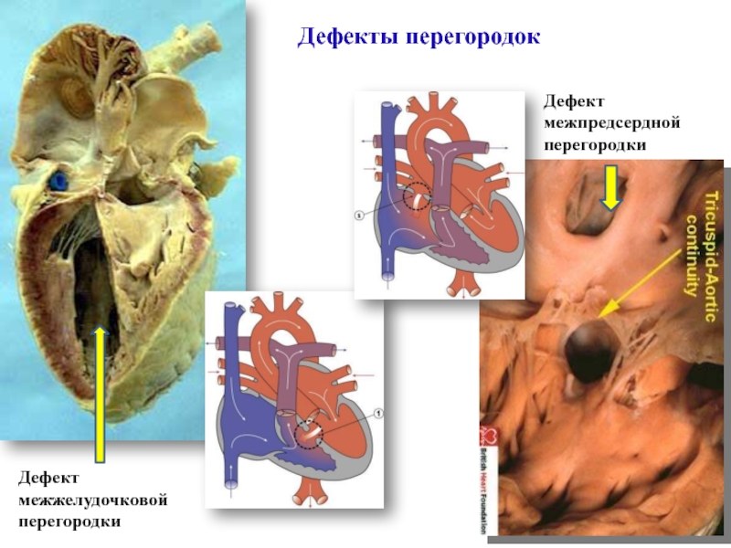 Дефект межжелудочковой перегородки презентация