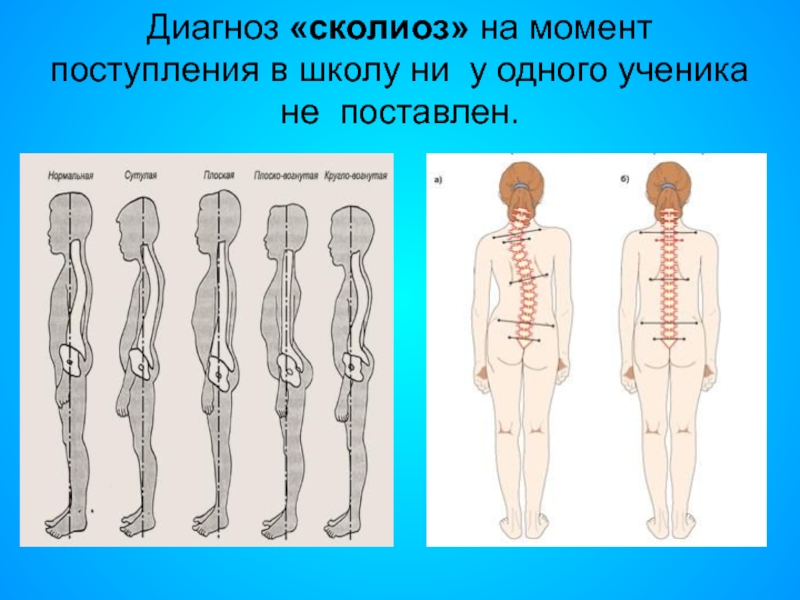 Проект на тему сколиоз 9 класс