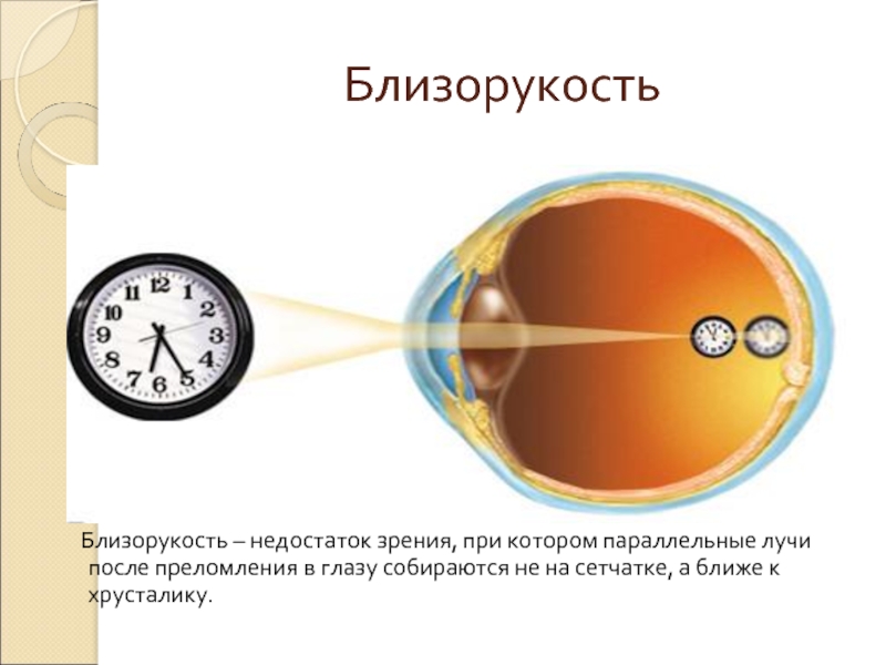 Близорукость  Близорукость – недостаток зрения, при котором параллельные лучи после преломления в глазу собираются не на