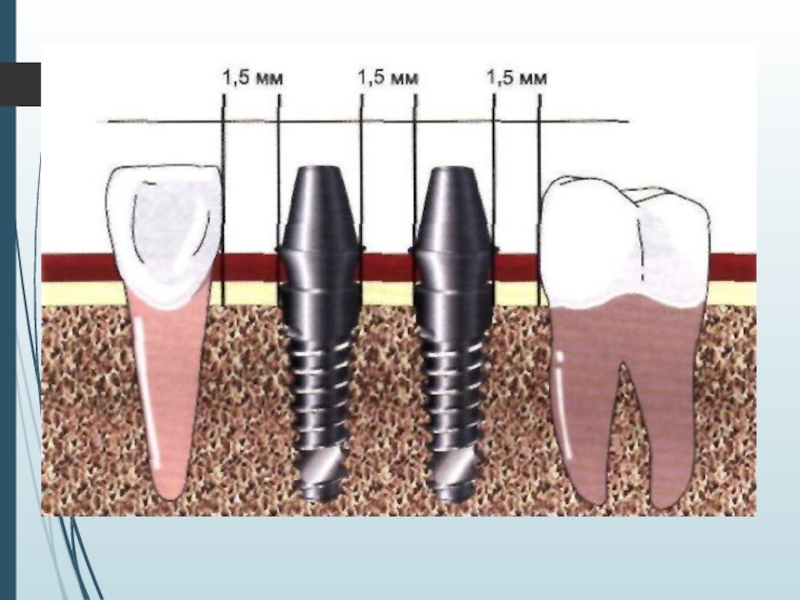 Зуб между имплантами. Этапы имплантации зубов абатмент. Этапы имплантации зуба абатмент. Этапы установления импланта зуба.