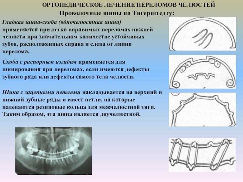 Переломы нижней челюсти стоматология презентация