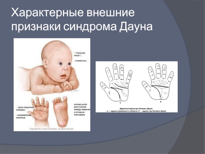 Признаки дауна у новорожденного. Фенотипические проявления синдрома Дауна. Синдром Дауна строение черепа. Внешние симптомы синдрома Дауна. Фенотип синдрома Дауна новорожденного.