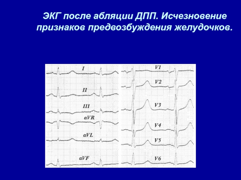 Экг презентация терапия