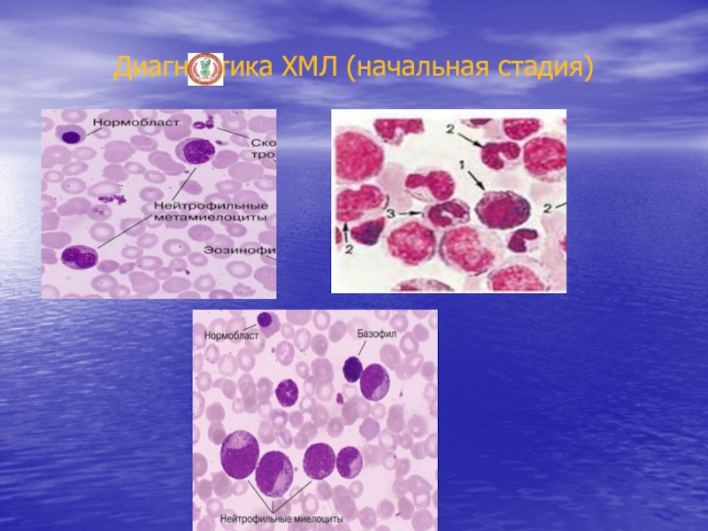 Хронические лейкозы презентация