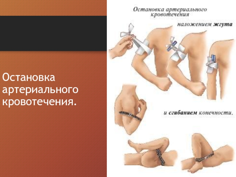 Для временной остановки артериального кровотечения необходимо выполнить. Остановка артериального кровотечени. Остановка артериаль кровотечения. Востановка артериального кровотечение. Порядок остановки артериального кровотечения.