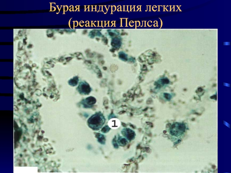 Бурая индурация легких это. «Бурая индурация лёгких» реакция Перлса. Бурая индурация легких патогенез. Реакция Перлса положительная.