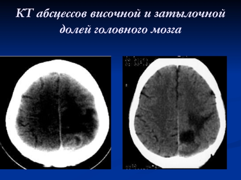 Абсцесс мозга симптомы. Риногенные абсцессы головного мозга. Абсцесс головного мозга кт. Кт абсцесс височной доли. Отогенные абсцессы височной доли мозга.