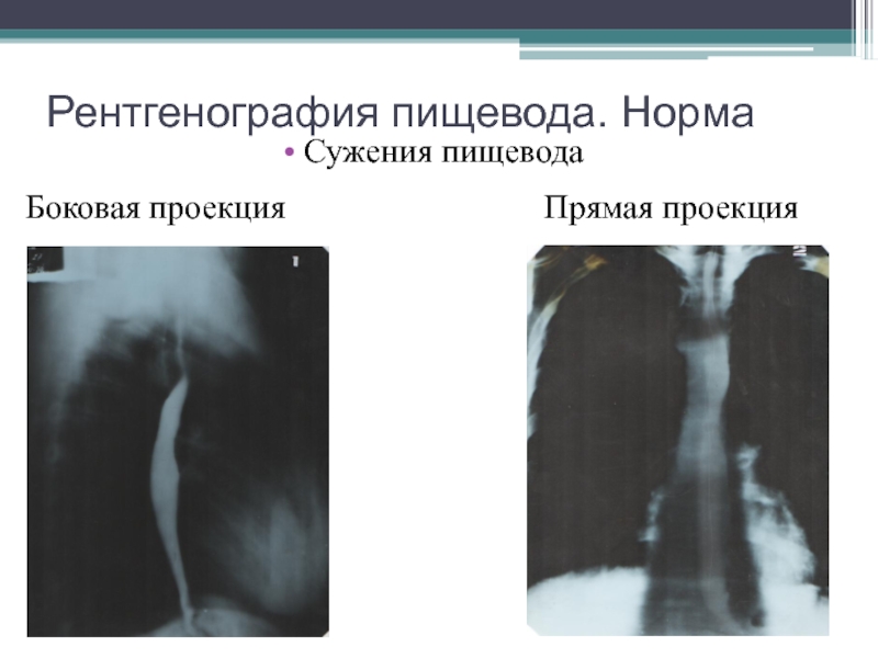 Рентген пищевода. Рентгеноскопия пищевода норма. Рентген пищевода в боковой проекции. Нормальный пищевод на рентгене.
