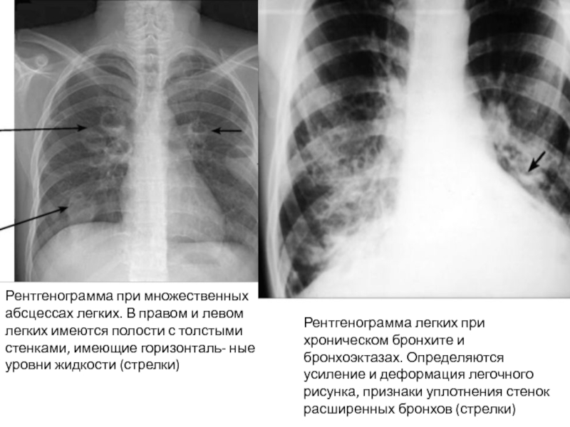 Лучевая картина абсцесса легких