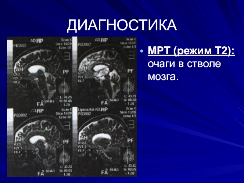 Режимы мрт головного мозга. Режимы мрт. Мрт т2 режим. Режимы в мрт диагностике. Режим PD на мрт.