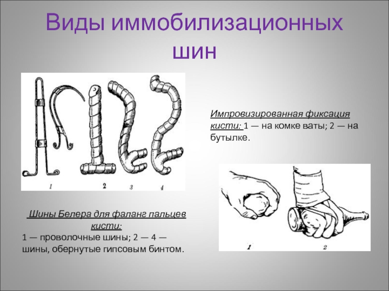 Виды иммобилизационных шин Шины Белера для фаланг пальцев кисти: 1 — проволочные шины; 2 — 4 —