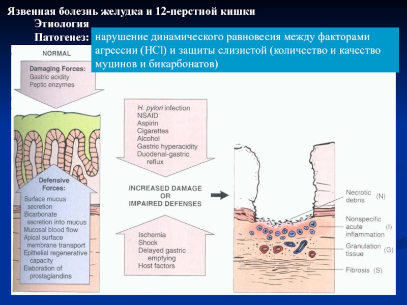 Язвенная болезнь патогенез схема