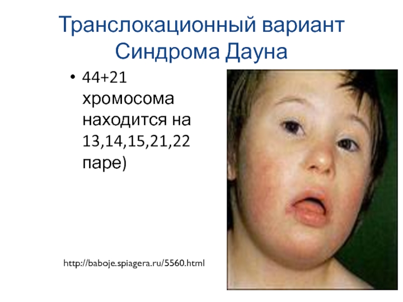 Фенотип ребенка с синдромом дауна. Транслокационная форма синдрома Дауна кариотип. Транслокационная форма болезни Дауна. Синдром Дауна Эдвардса. Транслокационная форма трисомии 21.