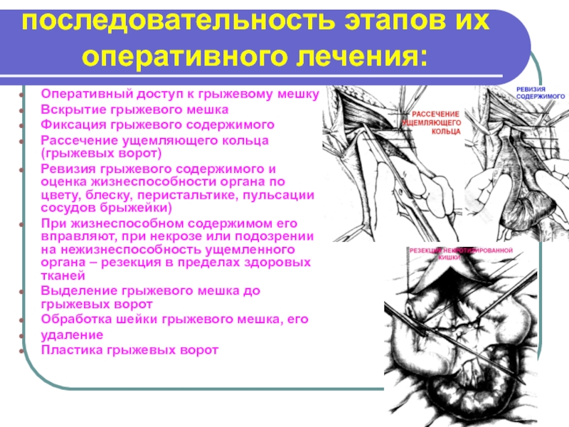 Схема мобилизации двенадцатиперстной кишки по кохеру линия рассечения