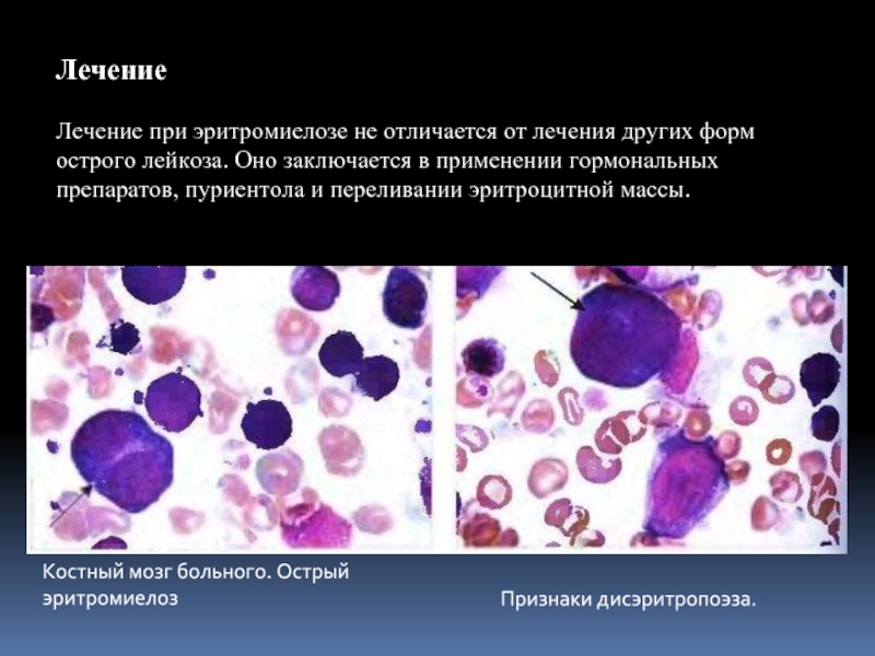 Миеломоноцитарный лейкоз картина крови