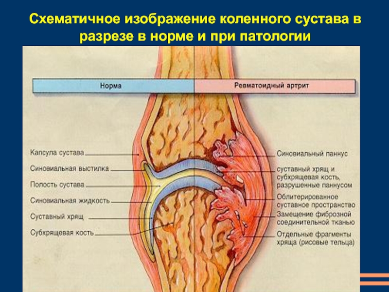 Ревматоидный артрит презентация