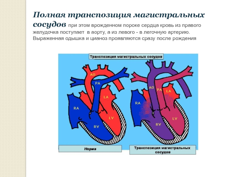 Транспозиция артерий