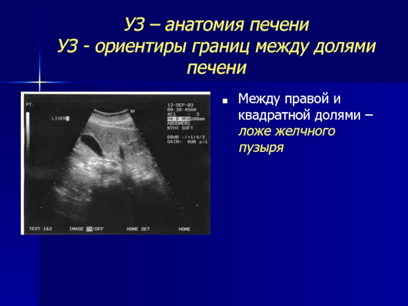 Сегменты печени на узи. Круглая связка печени на УЗИ. Ультразвуковая анатомия желчного пузыря. Ультразвуковая анатомия печени. Нормальная ультразвуковая анатомия печени.