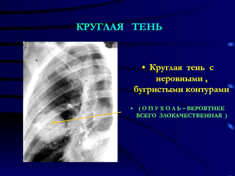 Солидные узелки правого легкого. Круглое образование в легком. Круглая тень с неровными контурами. Округлые тени в легких. Бугристые контуры легких ,что это такое.