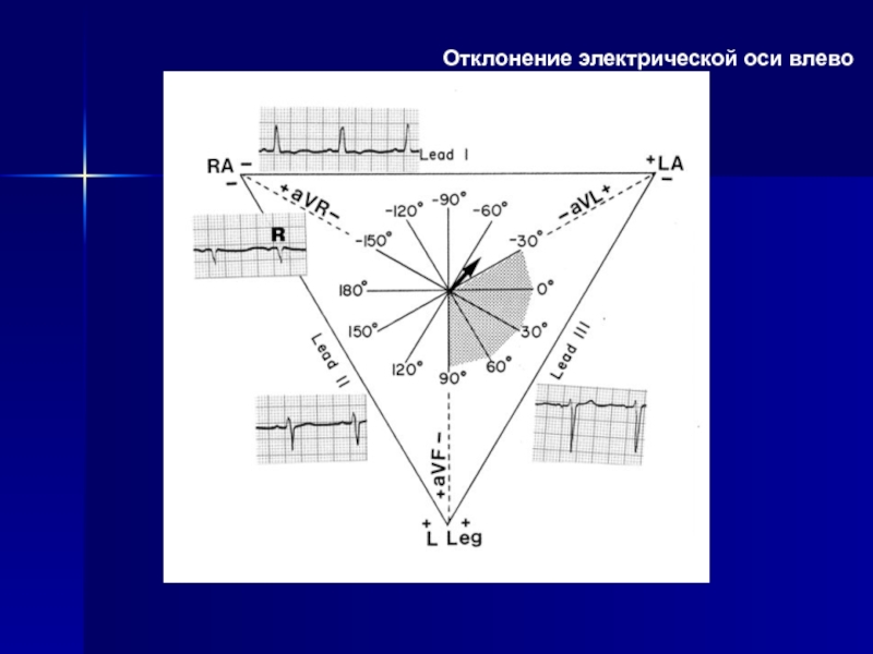 Отклонения оси. Отклонение электрической оси влево. Смещение электрической оси. Резкое отклонение электрической оси влево. Резкое смещение электрической оси влево.