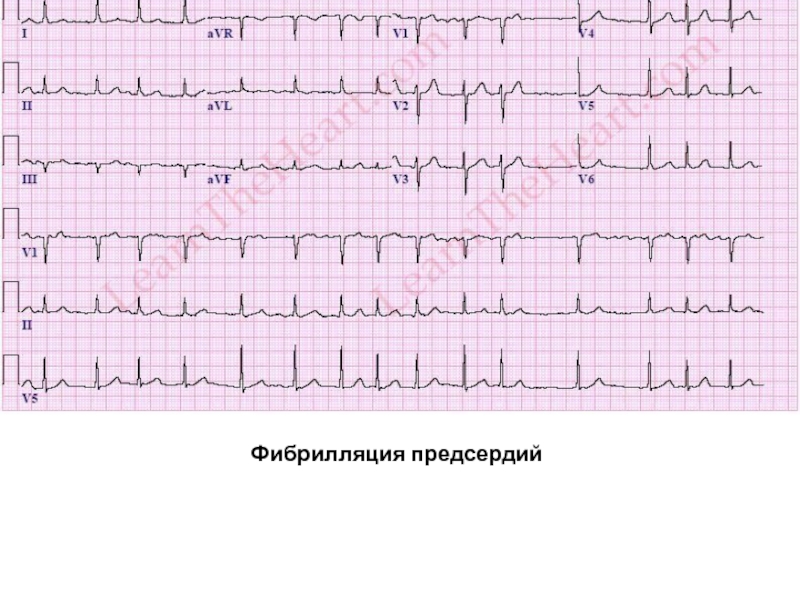 Фибрилляция предсердий что это. Пароксизм фибрилляции предсердий на ЭКГ. Фибрилляция предсердий ЭКГ расшифровка. Трепетание предсердий 2 к 1 на ЭКГ. Пароксизмальная фибрилляция предсердий на ЭКГ.