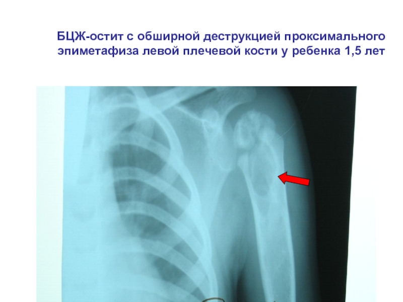 БЦЖ-остит с обширной деструкцией проксимального эпиметафиза левой плечевой кости у ребенка 1,5 лет