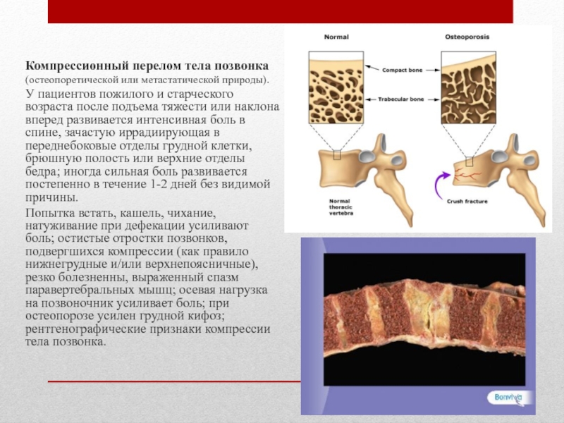 Компрессионный перелом карта вызова