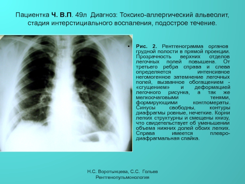 Что означает легочный рисунок деформирован