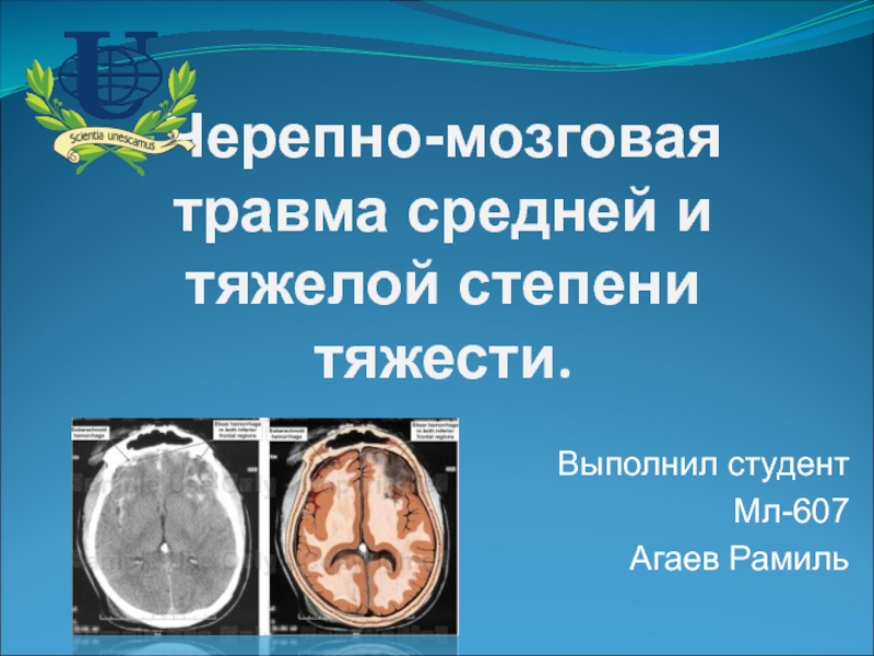 Презентация Черепно-мозговая травма средней и тяжелой степени тяжести