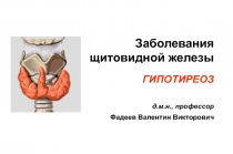 Тироидиты. Сндром гипотиреоза