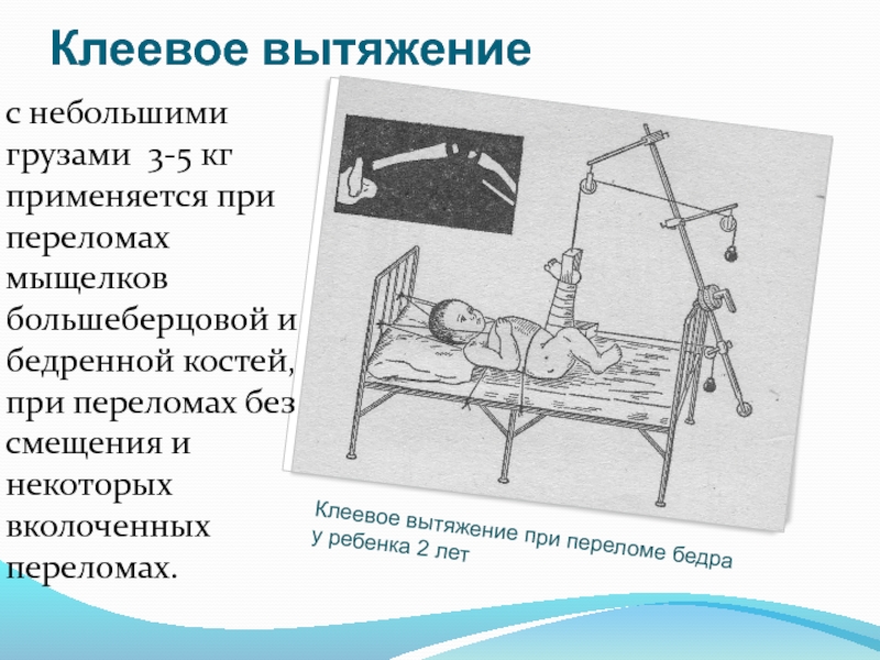 Схема скелетного вытяжения при переломах бедренной кости