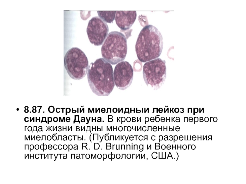 Кровотечения при лейкозе. Лейкемический синдром.