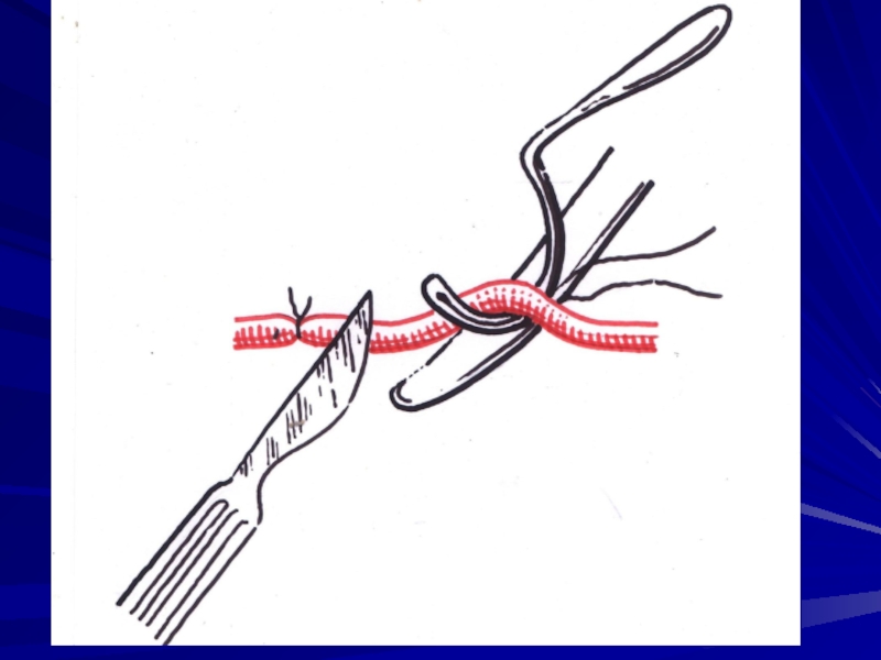 Перевязка в ране и на протяжении. Перевязка (лигирование) сосуда. Наложение лигатуры на артерию. Перевязка кровеносного сосуда. Лигирование кровоточащего сосуда.