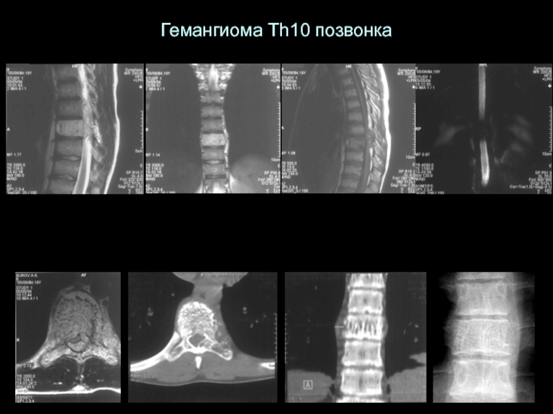 Опухоли спинного мозга презентация