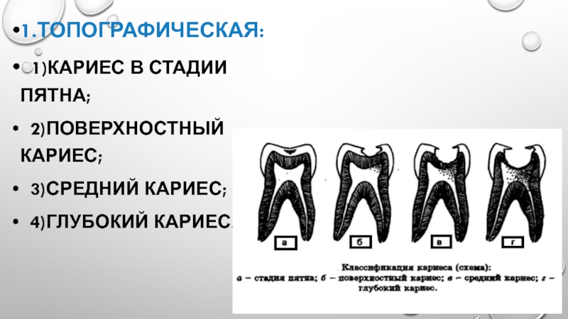 Классификация кариеса презентация