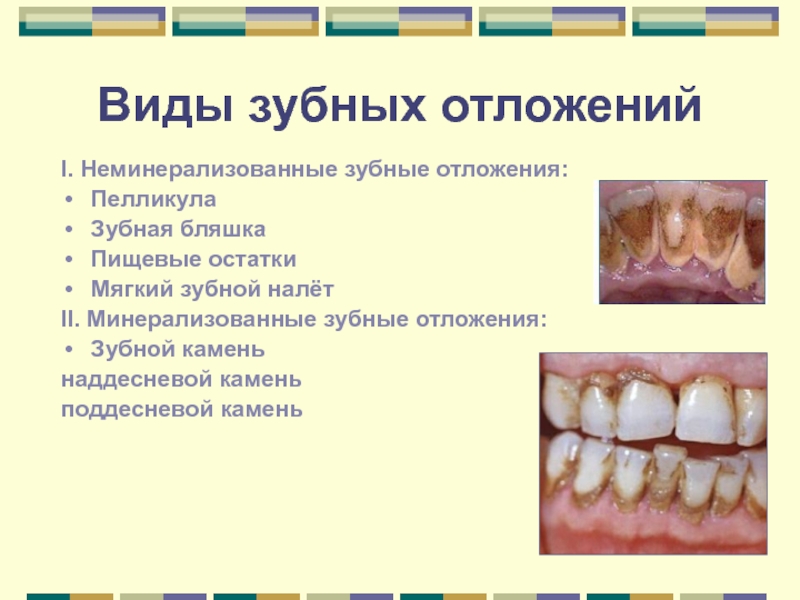 Реферат: Зубные отложения