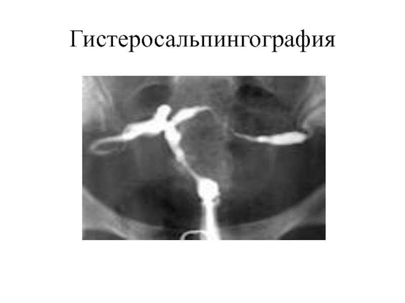 Гистеросальпингография эндометриоз