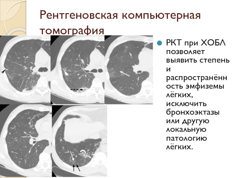 Лучевая диагностика хобл презентация