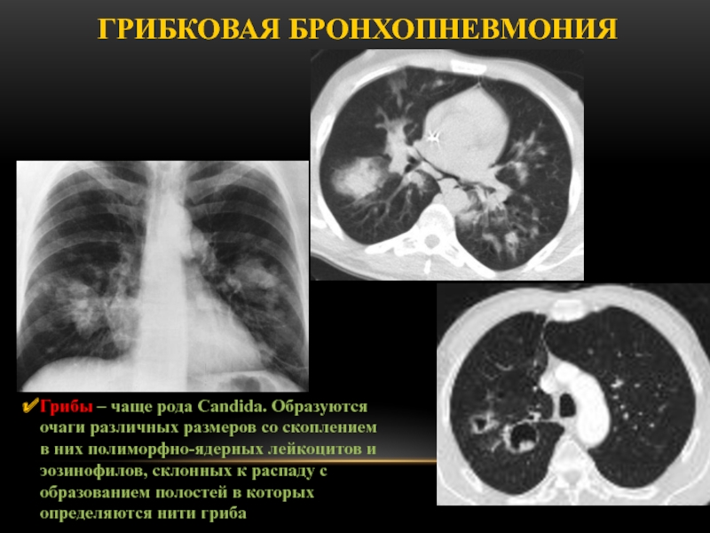 Бронхопневмония кт картина