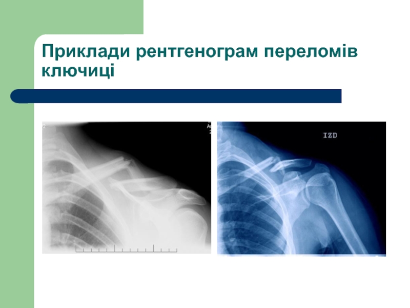 Перелом ключицы презентация