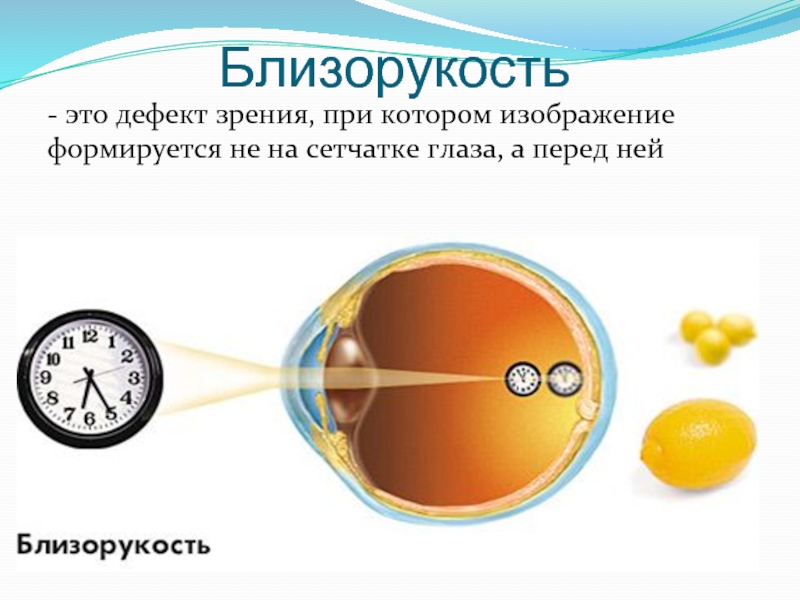 Изображение формируется перед сетчаткой