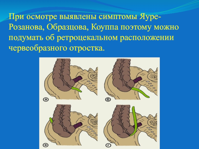 Выявленные при осмотре. Эмпиема червеобразного отростка. Ретроцекальное расположение червеобразного отростка. Пальпация червеобразного отростка.