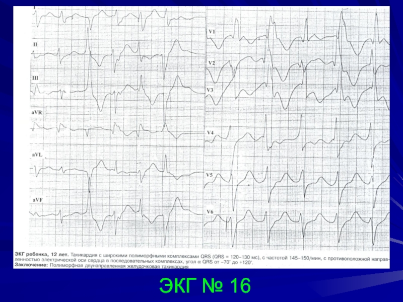 Умеренный ритм миокарда. Тахиаритмия на ЭКГ. ЭКГ №16. ЭКГ сбитый ритм. Умеренная тахиаритмия у ребенка.
