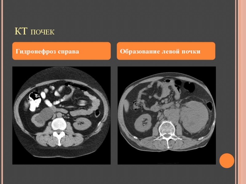Кт картина са левой почки