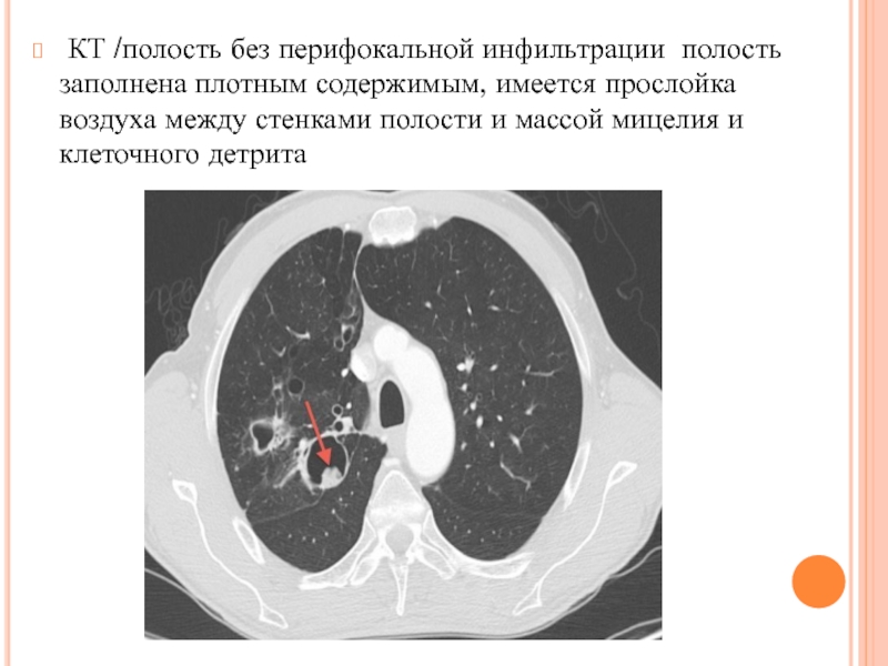 Без полости. Паразитарное поражение легких на кт. Перифокальная инфильтрация кт.